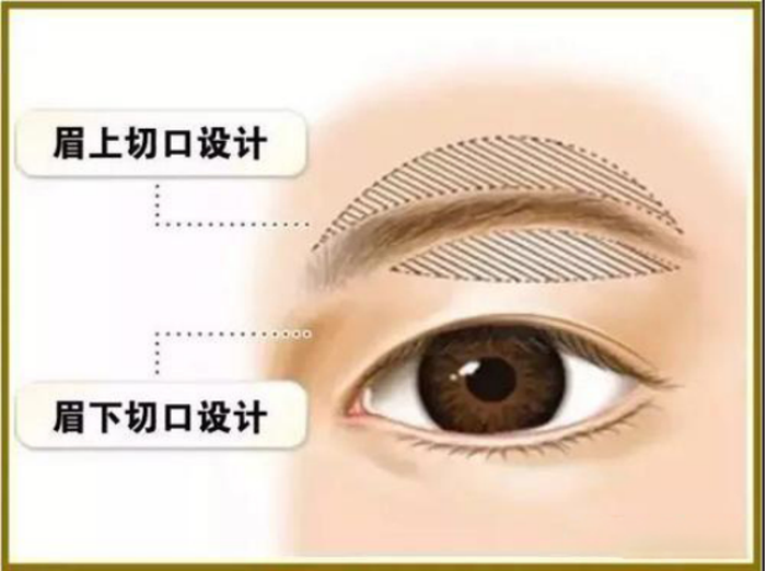 提眉或切眉术后可以不留疤吗