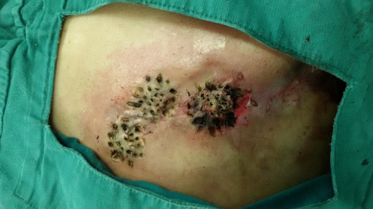 乳腺癌术后皮肤转移的克星高频电微创治疗