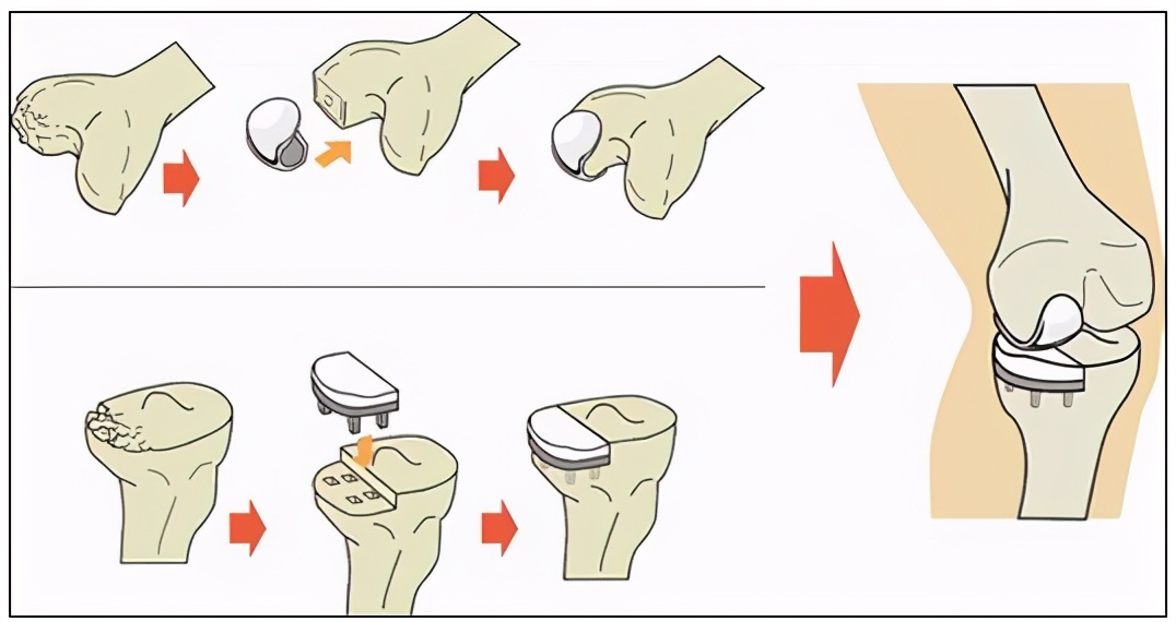 老人双膝疼痛十余年打上补丁单髁置换走起