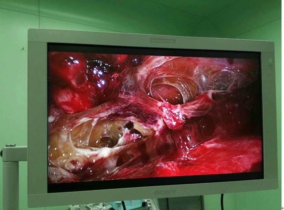 慢性脓胸的微创治疗