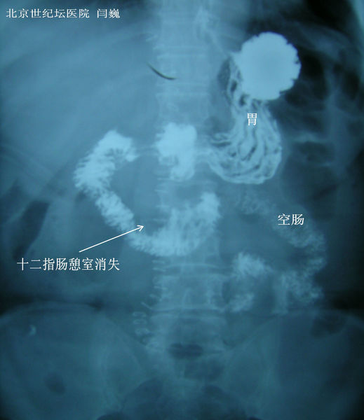 十二指肠憩室切除术