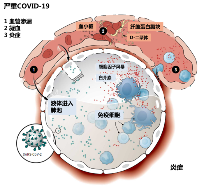 图:损伤级联:新的假设表明sars-cov-2攻击环绕肺泡的血管内皮细胞.