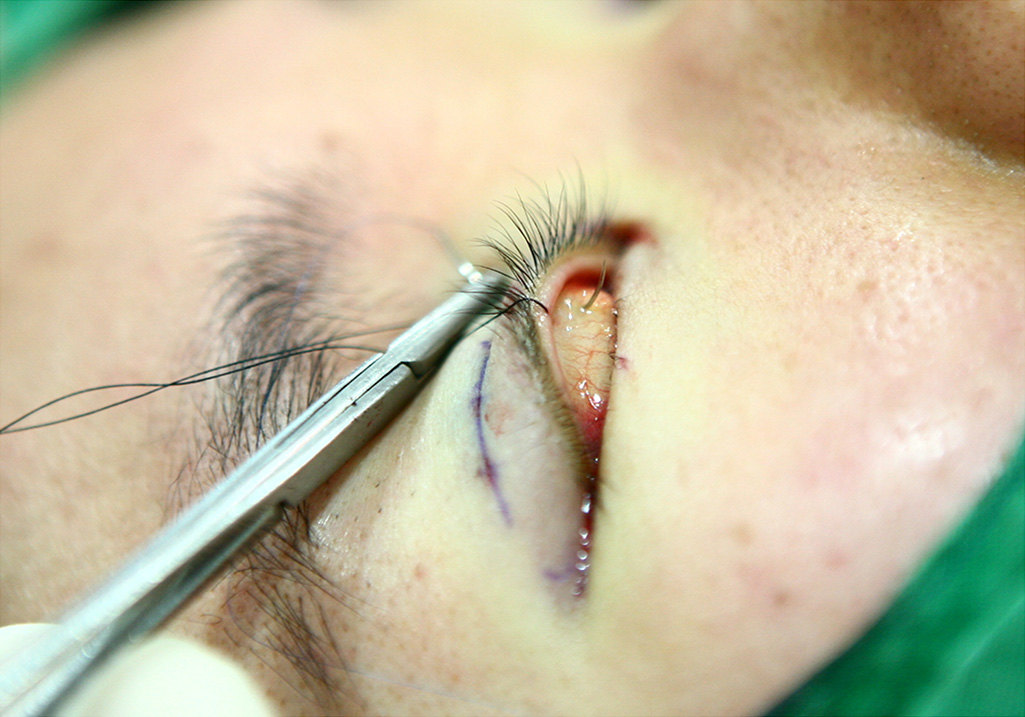 高清图真实案例解析埋线缝线双眼皮如何解决大小眼