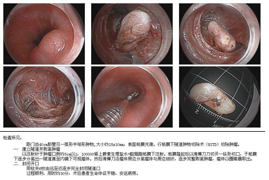 食管粘膜下肿物的诊断及内镜下治疗