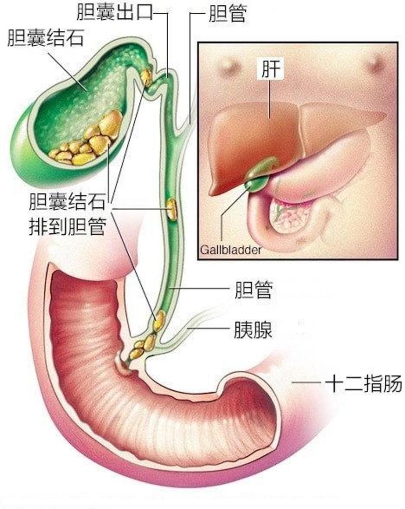 得了胆结石 怎么办 健康号 微医