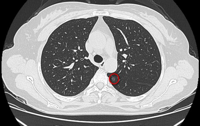 图3e术后病理(图3f)示:右肺下叶两枚病灶为微浸润腺癌,右肺上叶一枚为