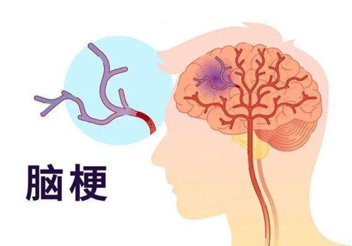 明明无症状却得了脑梗死是怎么回事