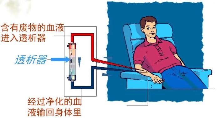 血液透析vs腹膜透析,慢性肾衰竭患者适合哪一种?