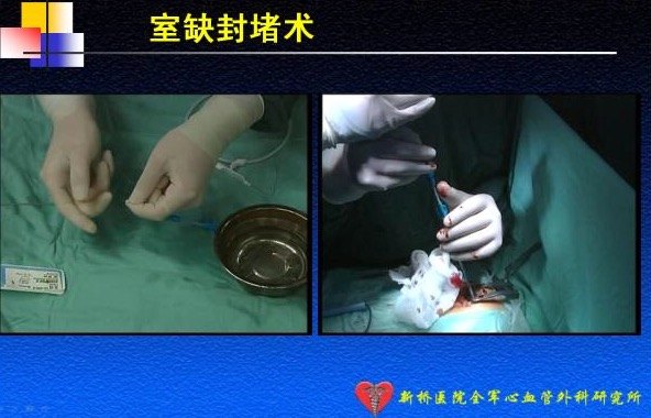 经胸微创室间隔缺损封堵术适合你吗