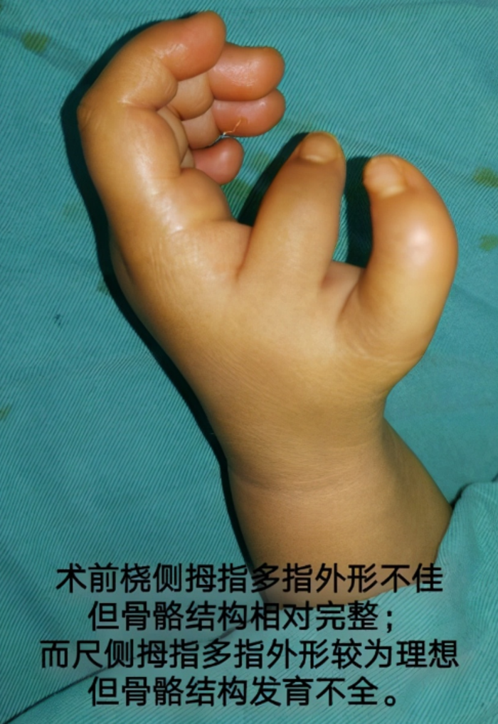 拇指多指治疗实例_陈江海医生文章_华中科技大学同济