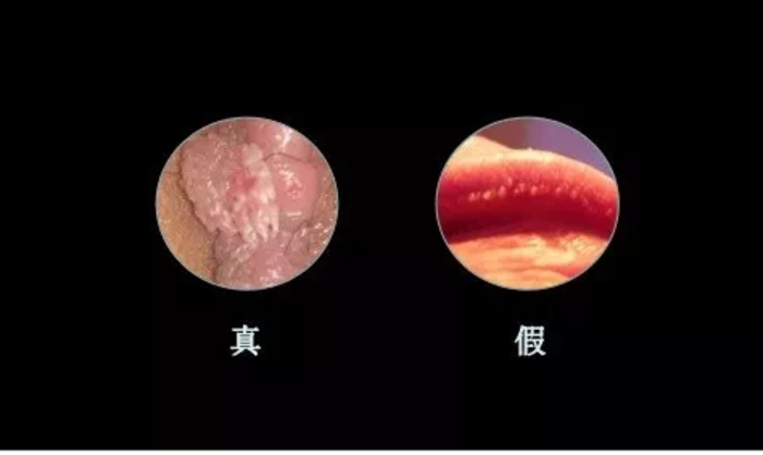 尖锐湿疣别慌也可能是假性湿疣