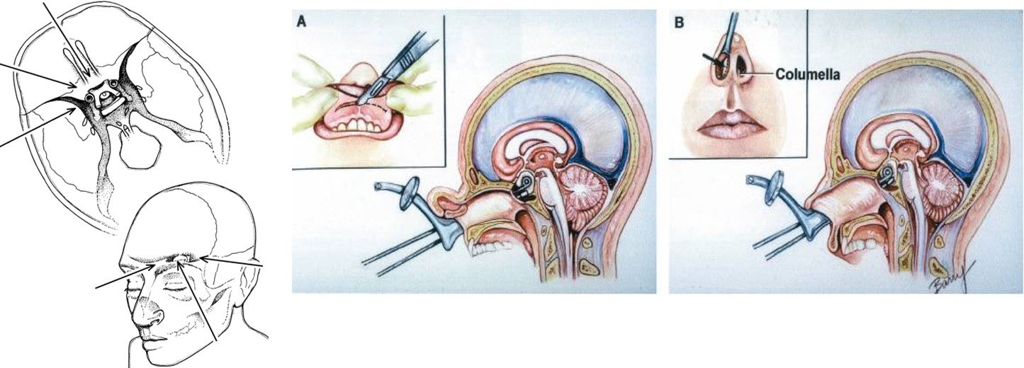 垂体瘤是什么垂体瘤的症状和治疗