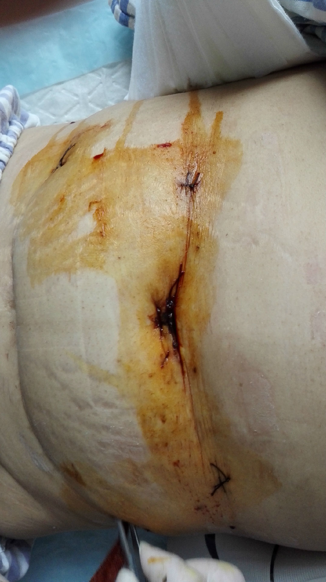 腹部无切口,超低位保肛-腹腔镜经肛外翻拖出式直肠癌根治术.