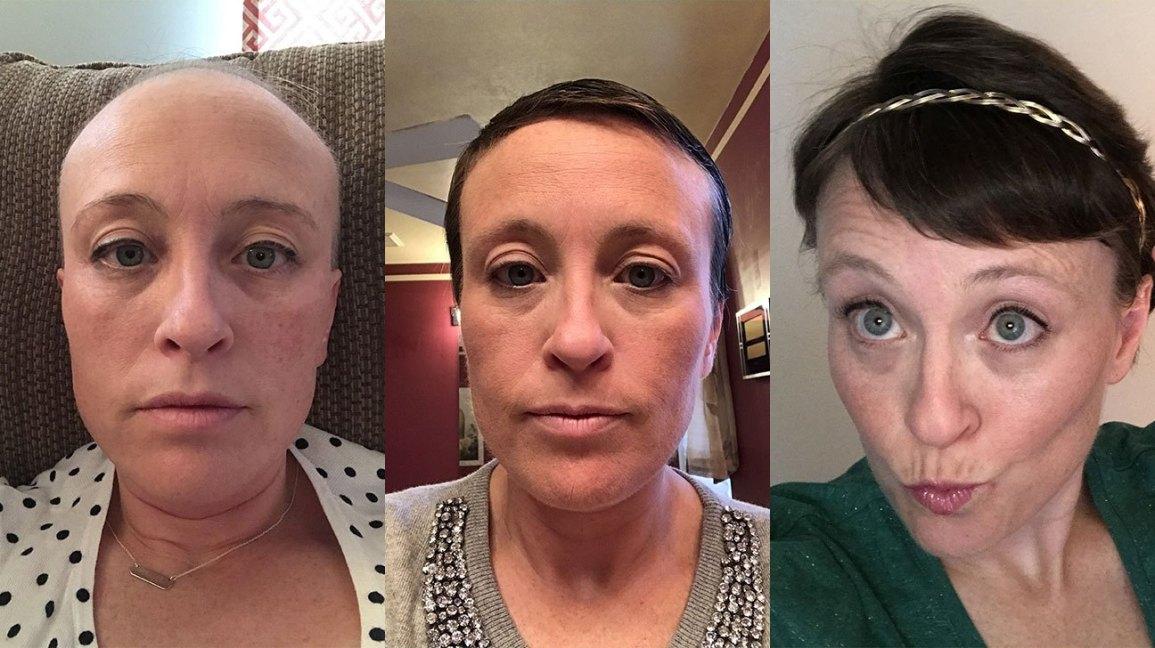 化疗为什么会掉头发?