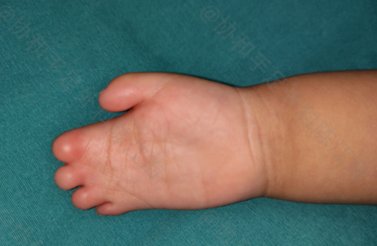 新生儿波兰综合症图片图片