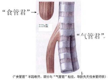 宝宝得了先天性食道闭锁怎么办