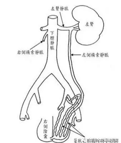 静脉血回流阻力以及静脉血流对左侧睾丸的冲击压力更大,因此造成左侧