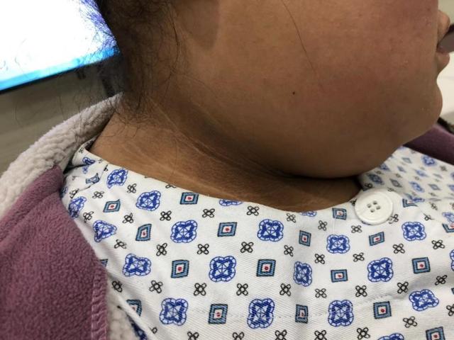 是肥胖导致的黑棘皮病! - 微医(挂号网)