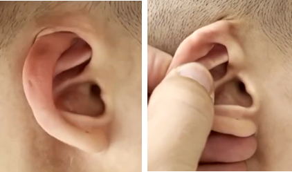 疾病科普向——如何让隐耳不隐_潘博医生文章_中国医学科学院整形外科