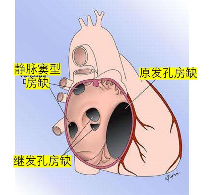 孩子房间隔缺损怎么办能自愈吗