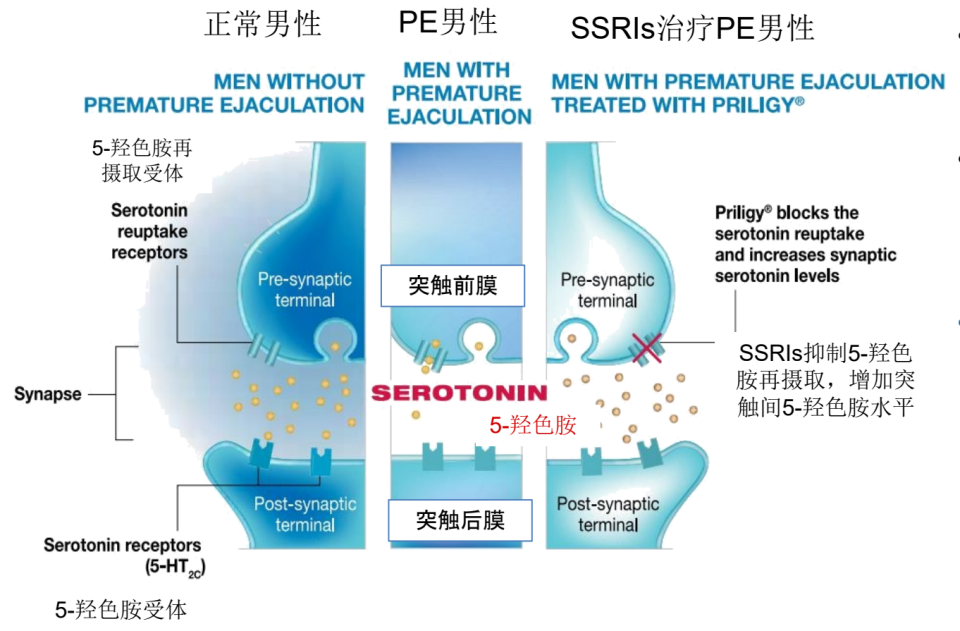 早泄吃达泊西汀没有效果,换成"长效ssris"有效吗?