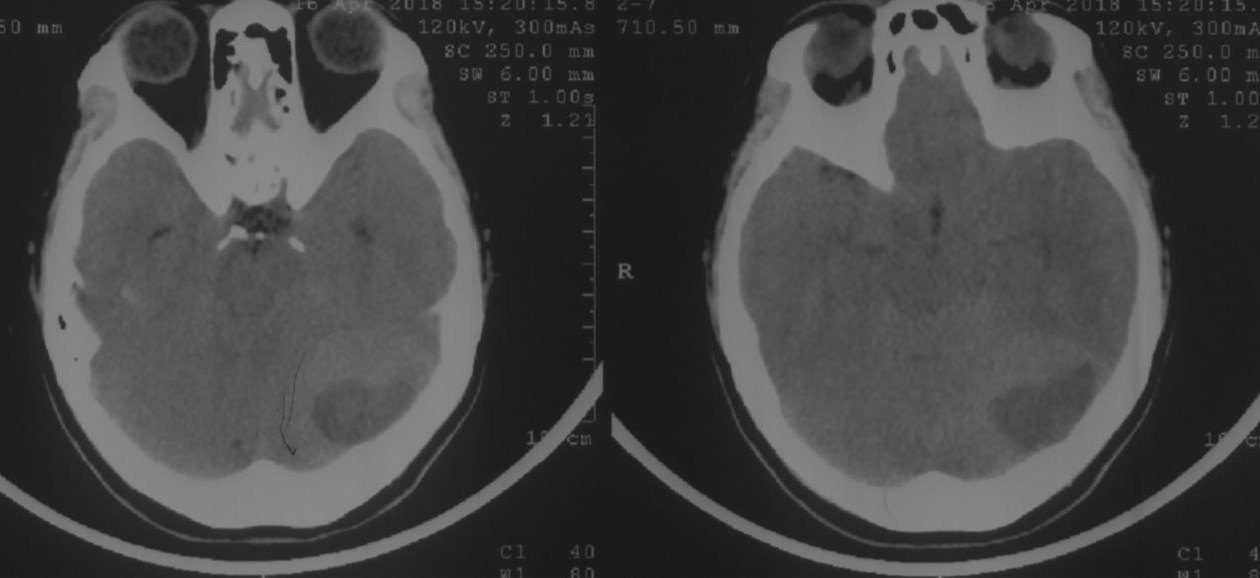 横窦天幕脑膜瘤手术一例 - 微医(挂号网)