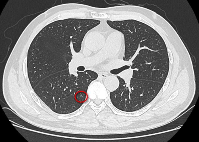 單孔胸腔鏡治療多發肺磨玻璃結節_肺癌_肺癌治療方式 - 好大夫在線