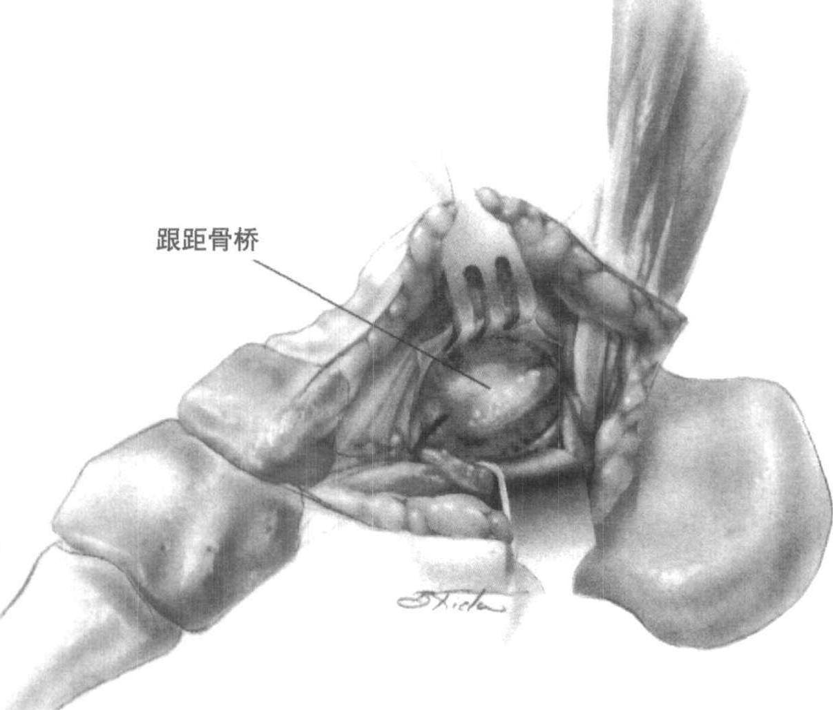 图4-143 距小腿(踝)关节与足关节及韧带(背面观)-骨科临床解剖学-医学