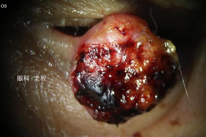 眼睑恶性肿瘤系列之鳞状细胞癌 - 微医(挂号网)