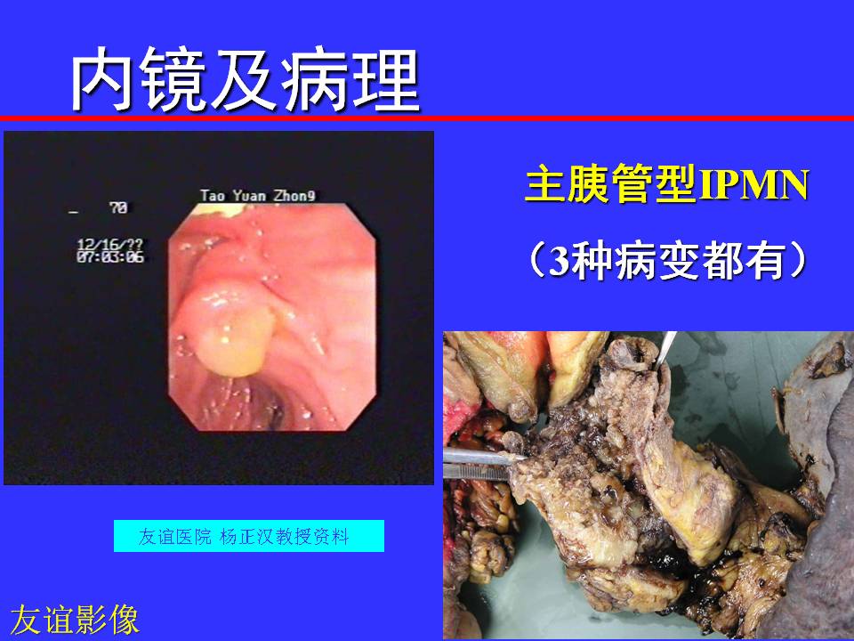 胰腺导管内乳头状黏液性肿瘤的磁共振表现