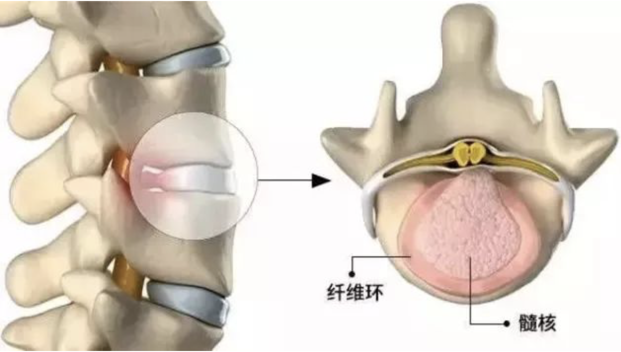 复合结构,内有胶冻状的起承压和分散能量的髓核以及外侧层状的纤维环