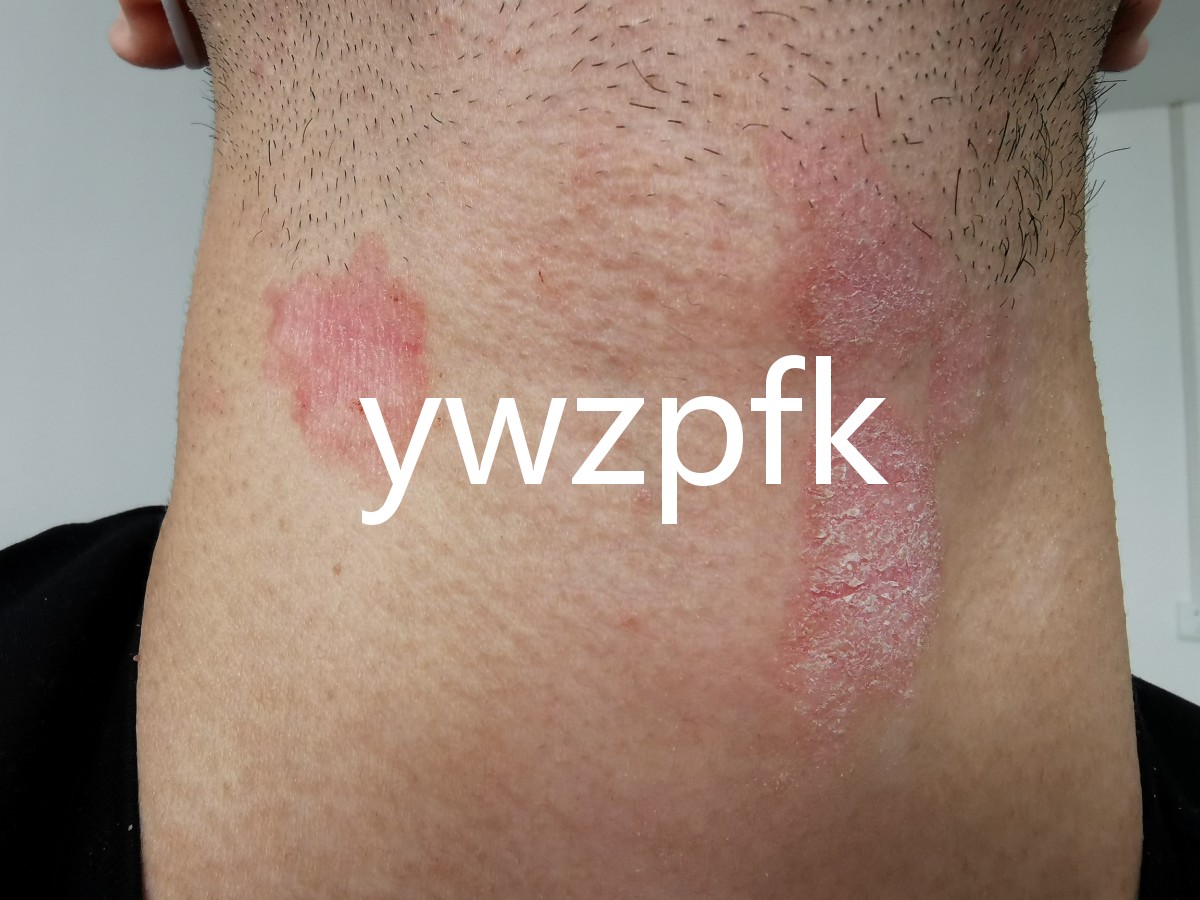 临床表现患者,男性,24岁,1年前无明显诱因出现颈部,耳后,腋窝皮疹