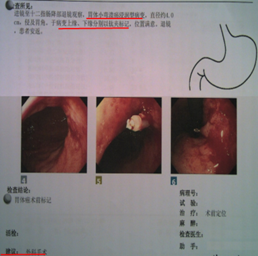胃高级别上皮内瘤变 严格把握手术适应征 健康号 微医