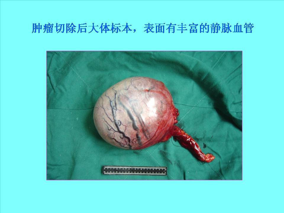 隐睾不治疗隐患不得了