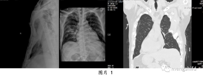 多发肋骨骨折和胸骨骨折合并连枷胸的手术治疗方 健康号 微医