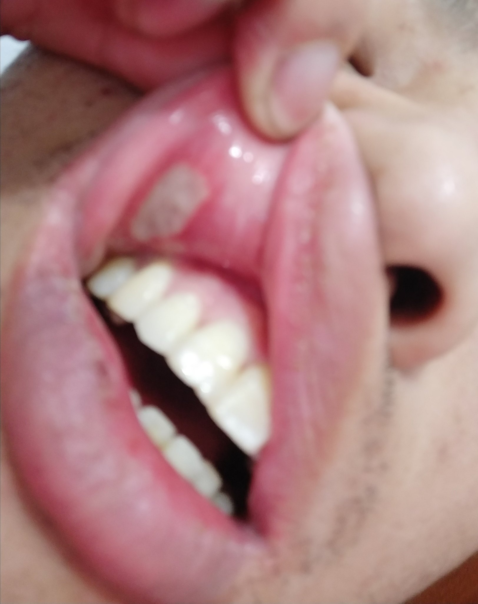 什么是复发性口腔溃疡_孙林琳医生文章_新乡医学院第一附属医院-微医