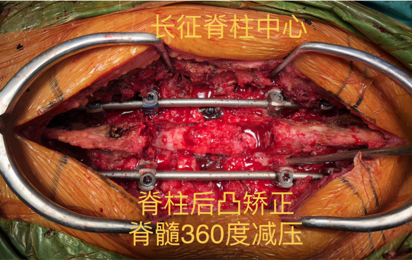 外伤导致驼背不全截瘫脊椎专家高难度手术成功矫形