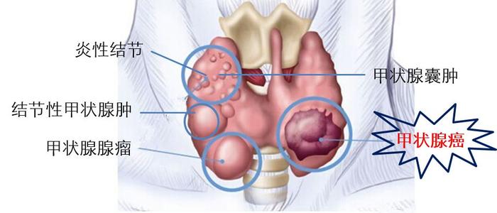如何鉴别甲状腺结节属于哪一类