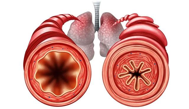 六旬大伯气管狭窄突发险情李鲁萍团队争分夺秒抢回生命