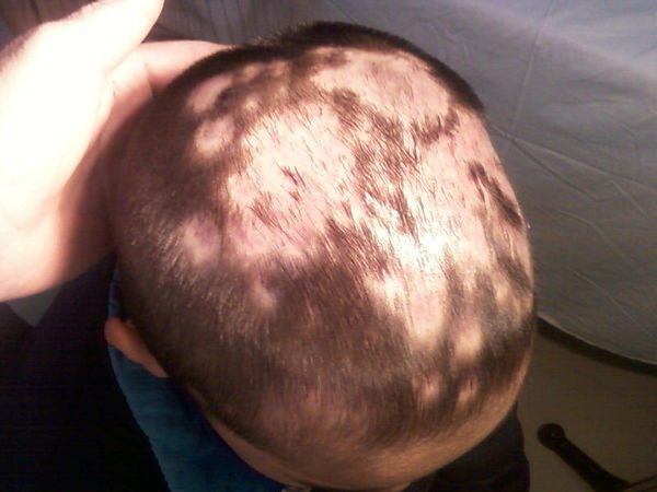 头癣引起脱发一例典型图片