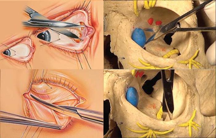 眼眶减压手术,切口和减压范围的关系漫谈! - 微医(挂号网)