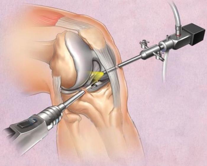 骨科医生带你了解半月板疾病半月板囊肿