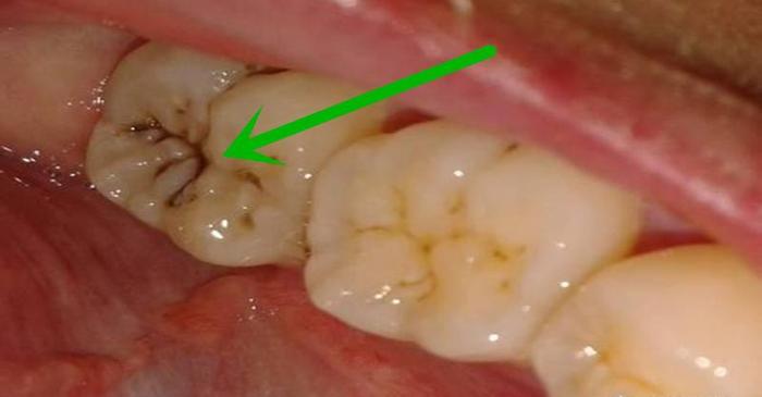 大洞吃苦,就是说的龋齿,龋齿的破坏程度一般可分为,浅龋,中龋和深龋