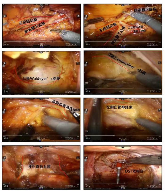 机器人低位直肠癌精准保肛手术无切口不造口有功能