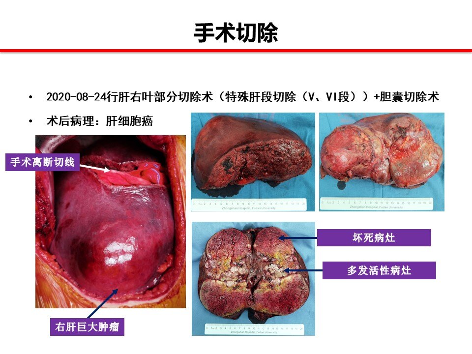 术后恢复病例总结该患者是中期肝癌患者,多发肿瘤累及肝门部管道,手术