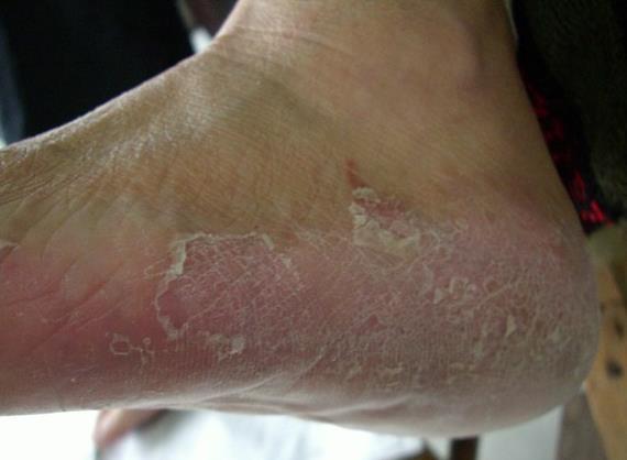 手足癣认识 - 微医(挂号网)