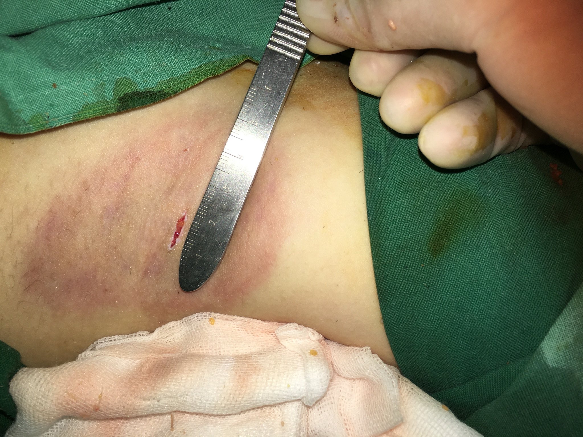 微切口腋臭根除手术不是微创手术