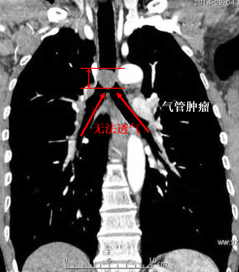 气管肿瘤的早期症状?能活多久?哪些患者需要手术治疗?