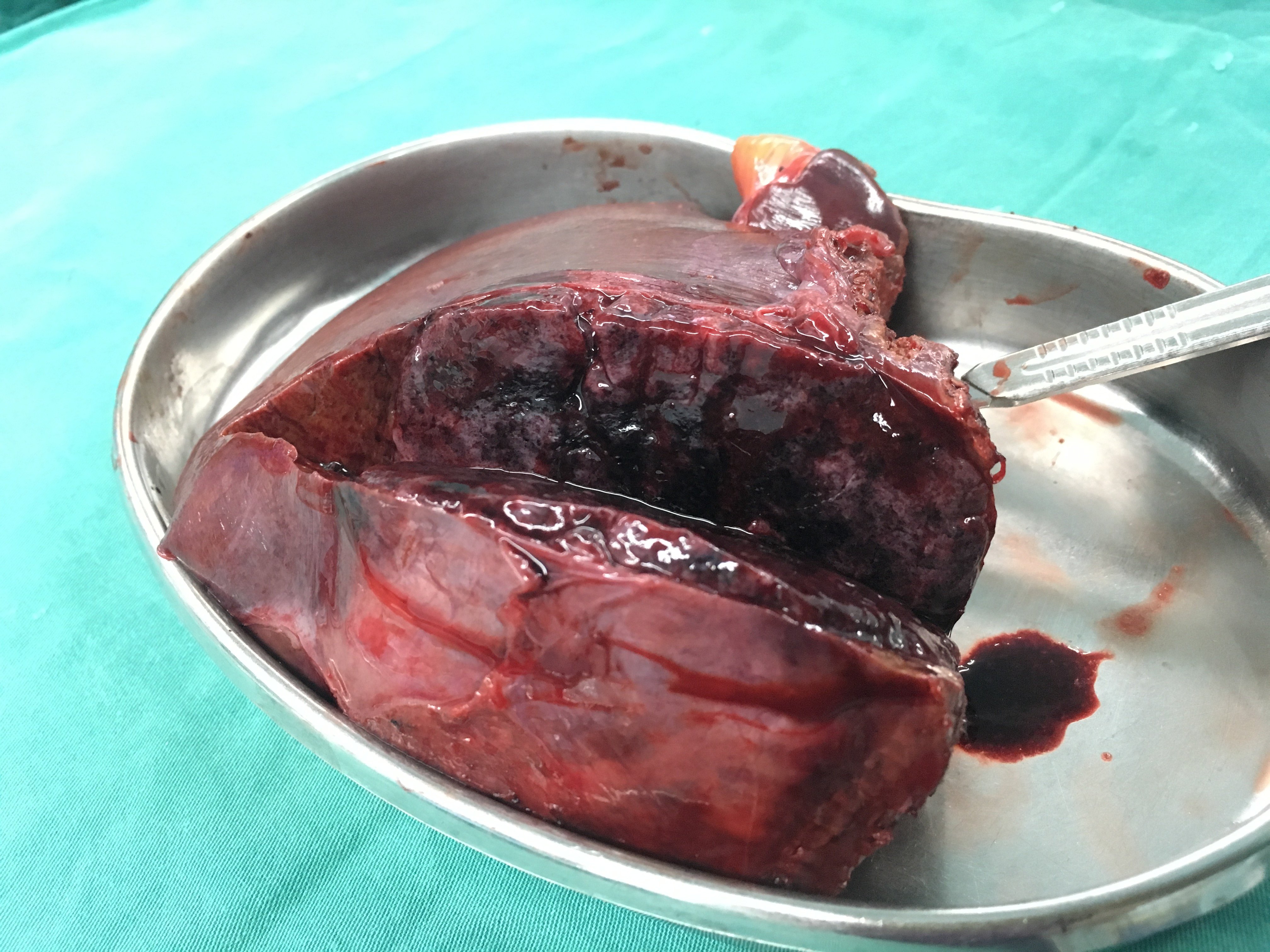 肝脏第四段大肿瘤压迫肝中静脉行左半肝切除_王兆文医生文章_上海交通