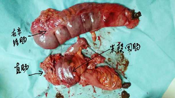 结肠癌切除的肠子图片图片